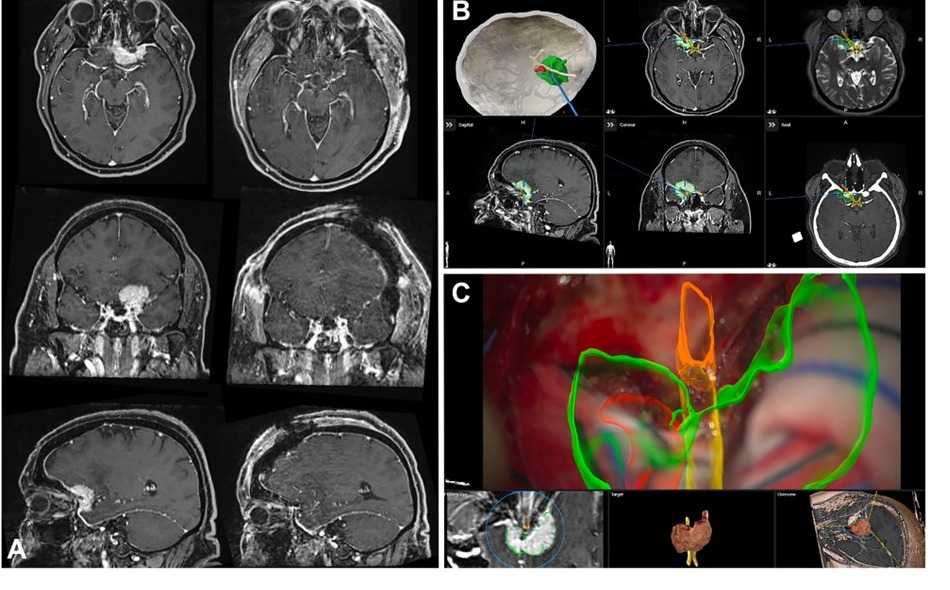 Caso clinico di meningioma di grado 1: RM preoperatoria, pianificazione 3D e vista intraoperatoria con realtà aumentata