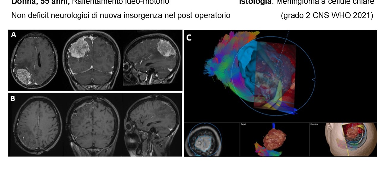 Caso clinico di meningioma a cellule chiare di grado 2: RM pre e post-operatoria e trattografia con pianificazione dell'accesso chirurgico