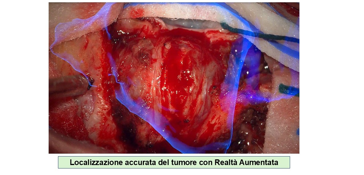 Localizzazione intraoperatoria del tumore con realtà aumentata
