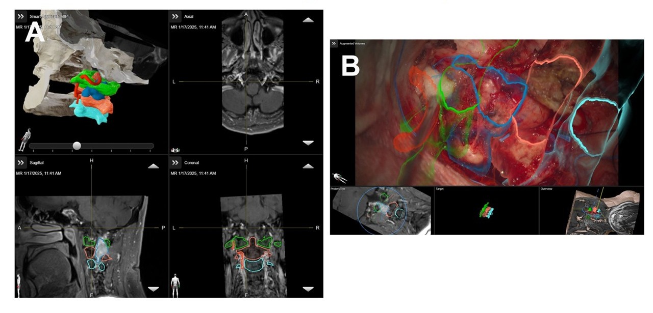 Pianificazione con realtà aumentata e neuronavigazione dello schwannoma C2