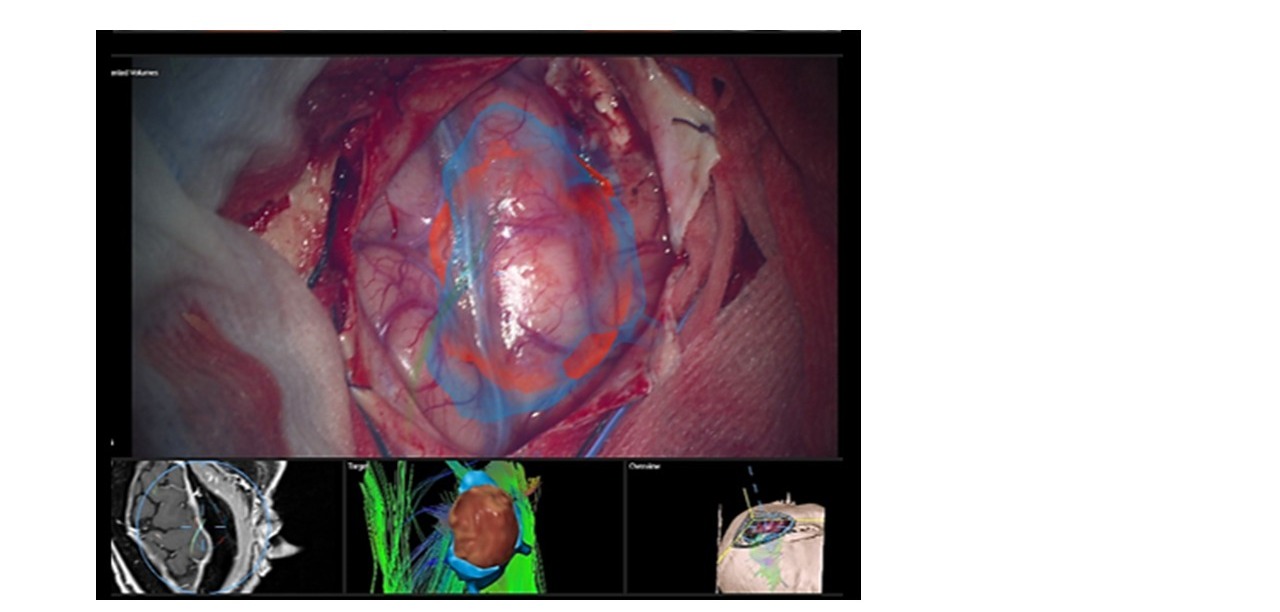 Realtà aumentata applicata alla chirurgia dei tumori cerebrali, con sovrapposizione di trattografia e target tumorale