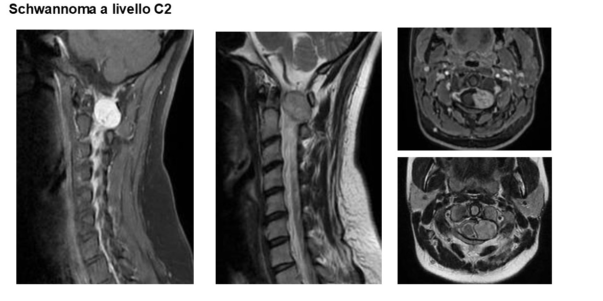 RM preoperatoria di schwannoma a livello C2